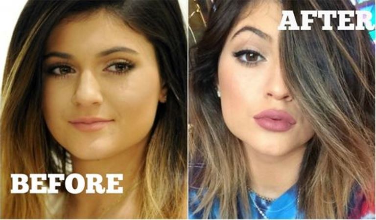 Kylie Plastic Surgery