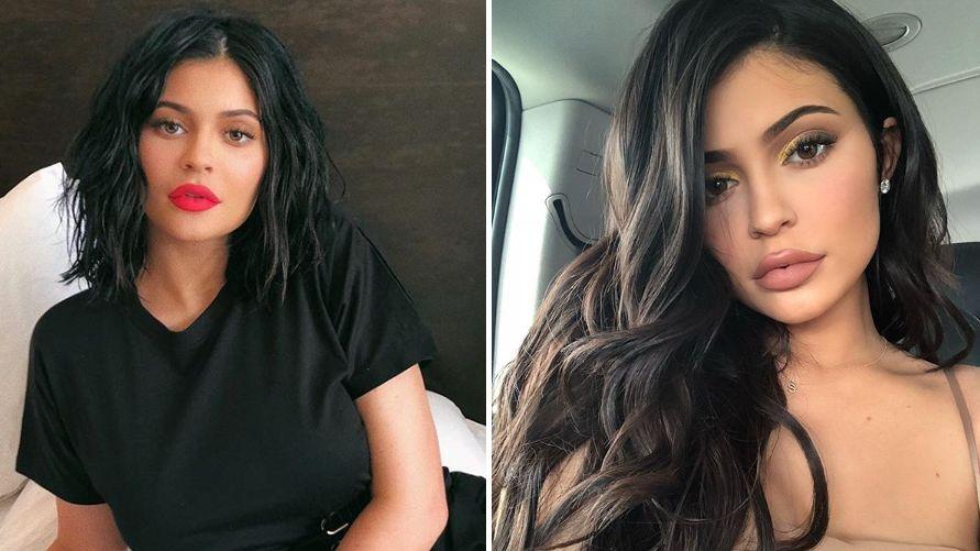 Kylie Jenner’s Lips And Nose Job; Before And After Surgery