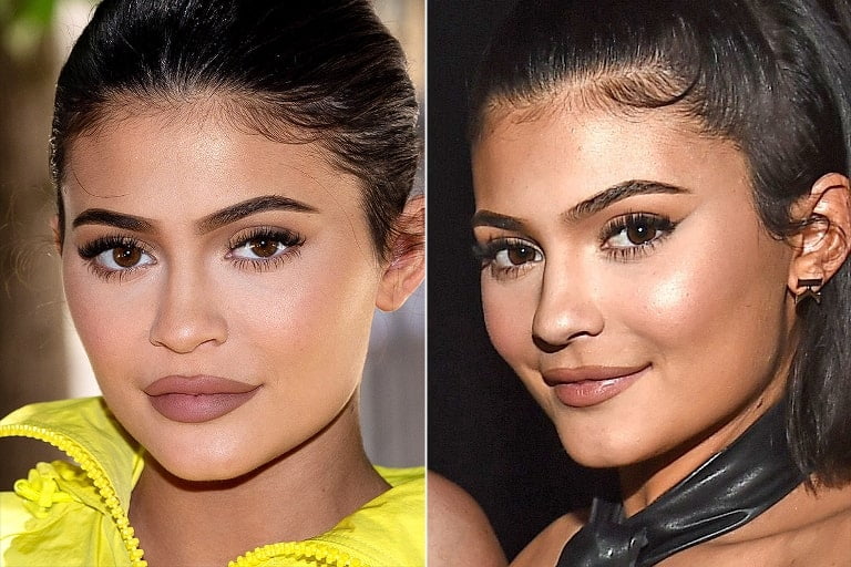 Kylie Jenner’s Lips And Nose Job; Before And After Surgery