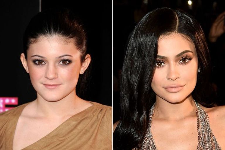 Kylie Jenner’s Nose Job