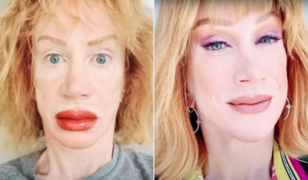 Kathy Griffin lip tattoo procedure goes awry leaving her lips swollen and bruised.